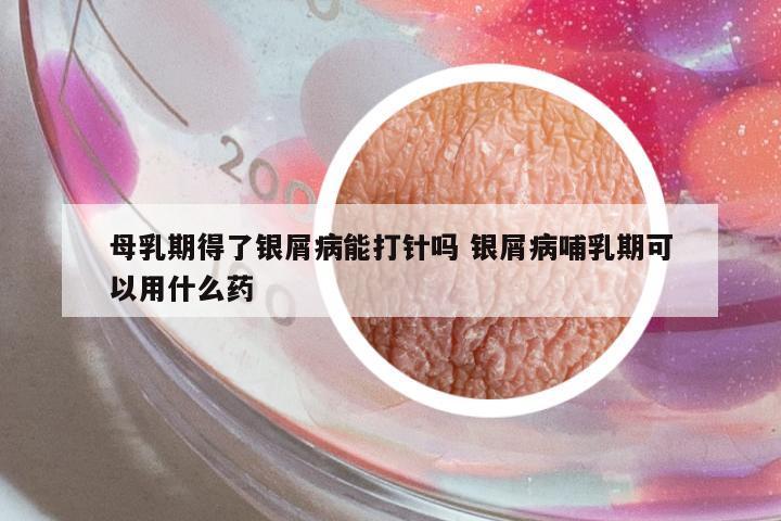 母乳期得了銀屑病能打針嗎 銀屑病哺乳期可以用什么藥