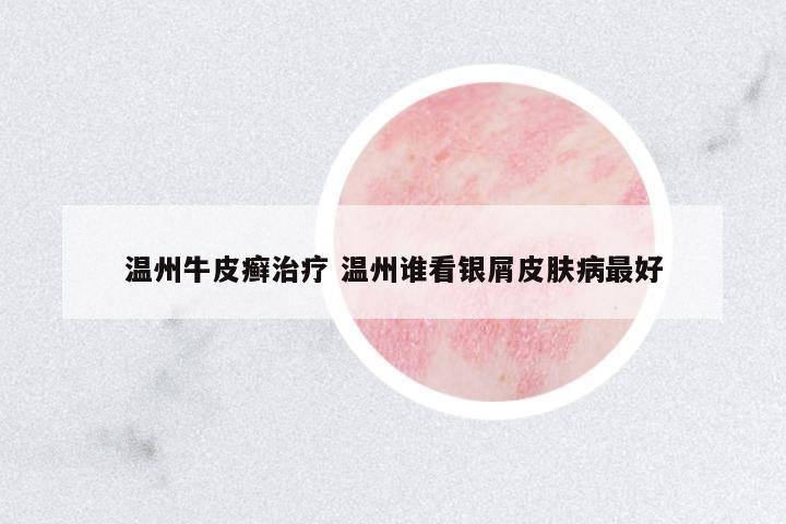 溫州牛皮癬治療 溫州誰看銀屑皮膚病最好