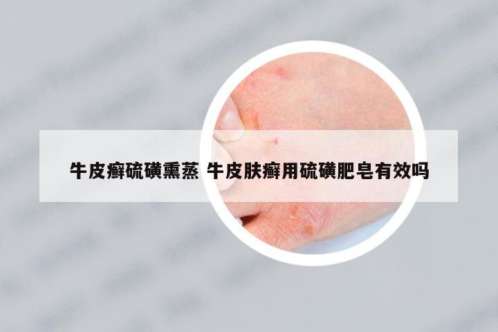 牛皮癬硫磺熏蒸 牛皮膚癬用硫磺肥皂有效嗎