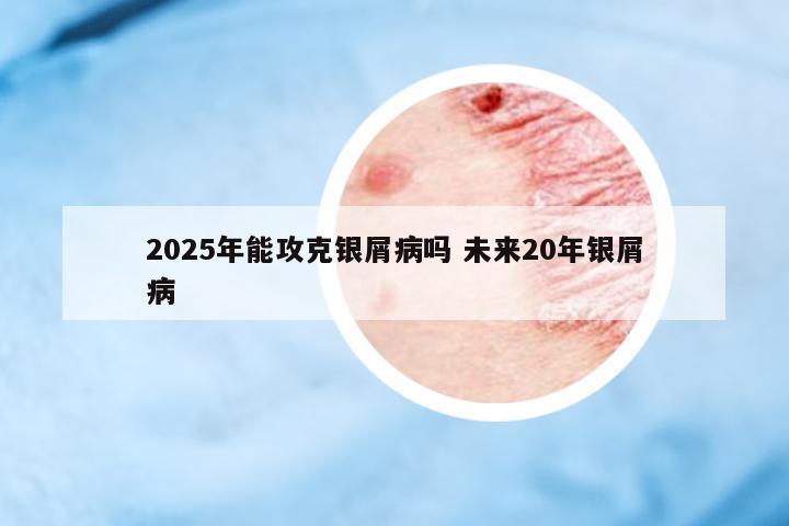 2025年能攻克銀屑病嗎 未來(lái)20年銀屑病