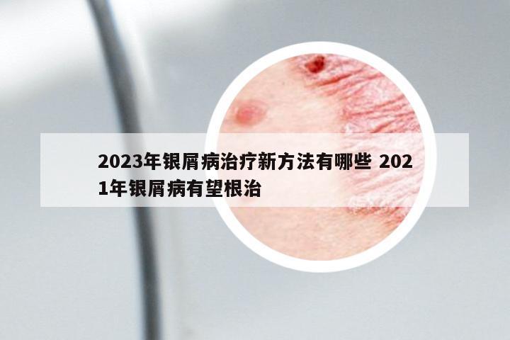 2023年銀屑病治療新方法有哪些 2021年銀屑病有望根治