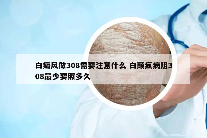 白癜風(fēng)做308需要注意什么 白顛瘋病照308最少要照多久