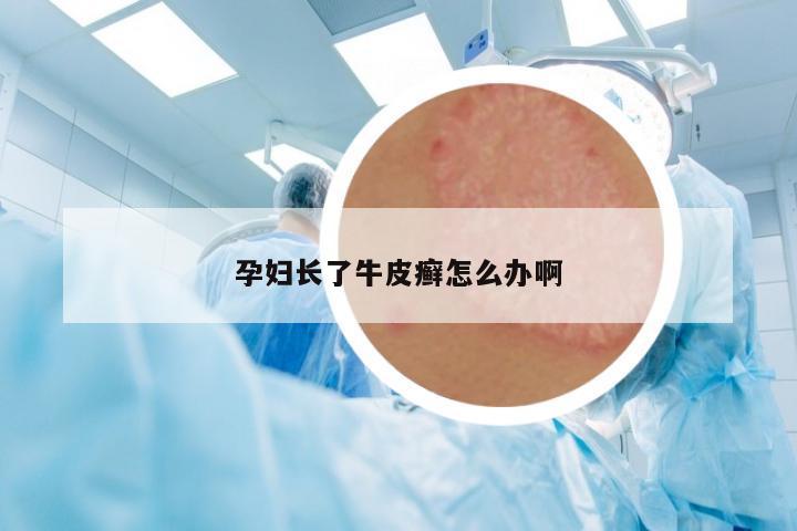 孕婦長(zhǎng)了牛皮癬怎么辦啊