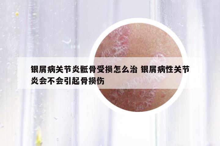 銀屑病關(guān)節(jié)炎骶骨受損怎么治 銀屑病性關(guān)節(jié)炎會不會引起骨損傷