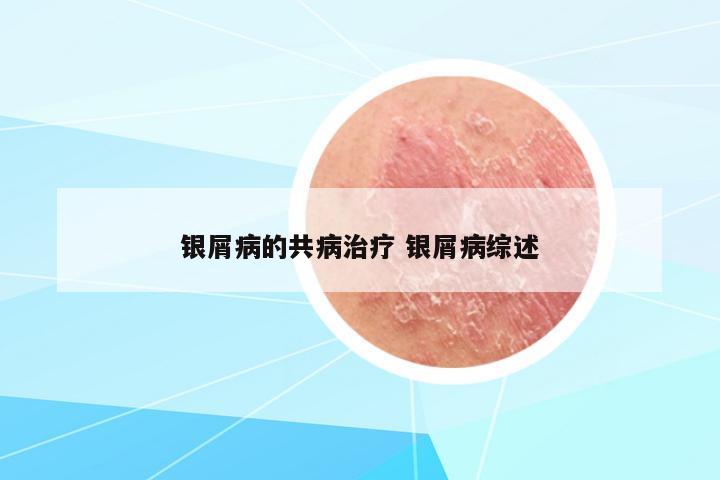 銀屑病的共病治療 銀屑病綜述