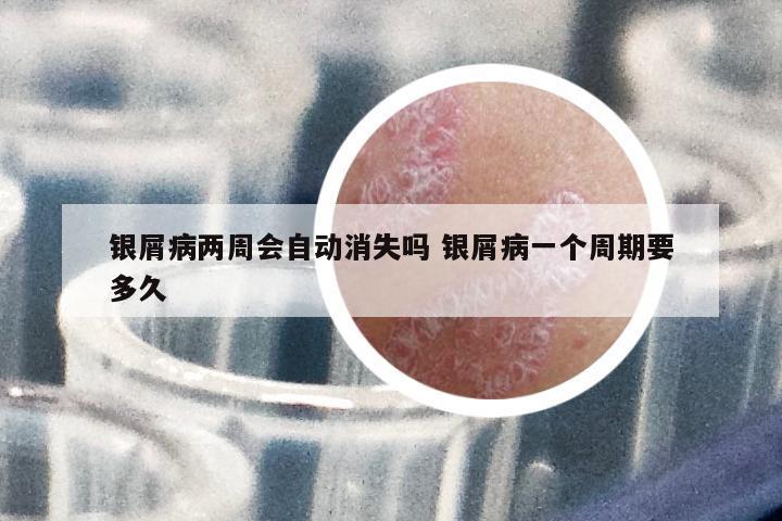 銀屑病兩周會(huì)自動(dòng)消失嗎 銀屑病一個(gè)周期要多久