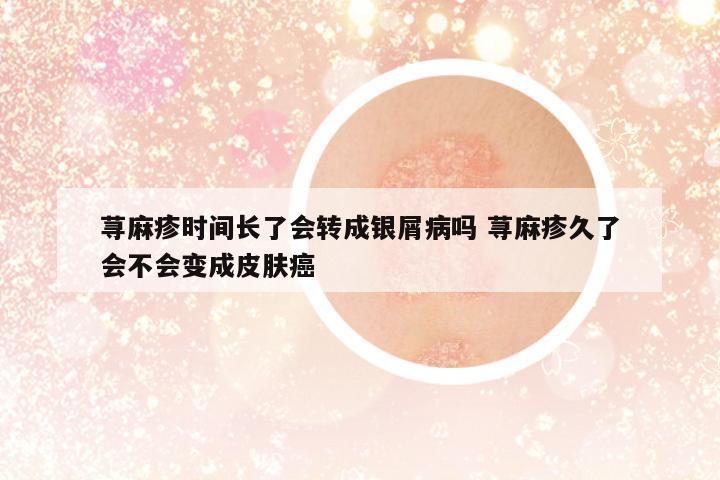 蕁麻疹時(shí)間長(zhǎng)了會(huì)轉(zhuǎn)成銀屑病嗎 蕁麻疹久了會(huì)不會(huì)變成皮膚癌