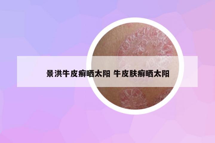 景洪牛皮癬曬太陽 牛皮膚癬曬太陽