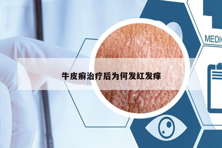 牛皮癬治療后為何發(fā)紅發(fā)癢