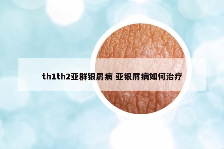 th1th2亞群銀屑病 亞銀屑病如何治療