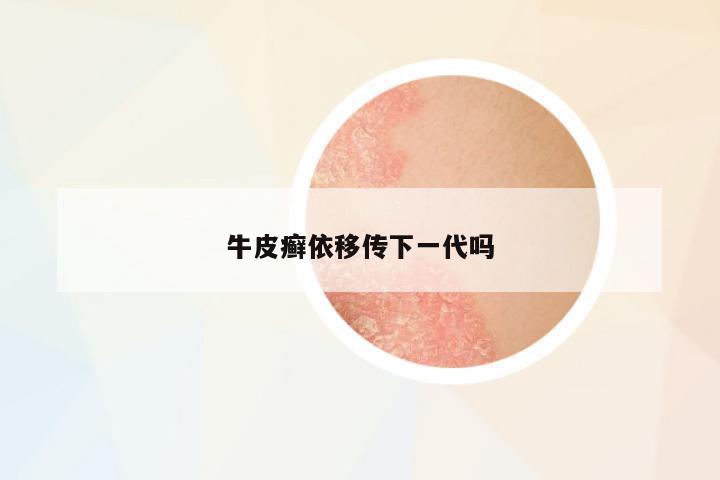 牛皮癬依移傳下一代嗎
