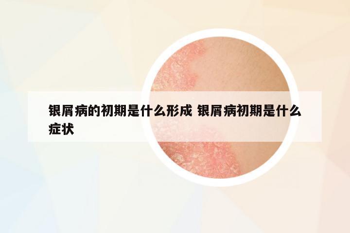 銀屑病的初期是什么形成 銀屑病初期是什么癥狀