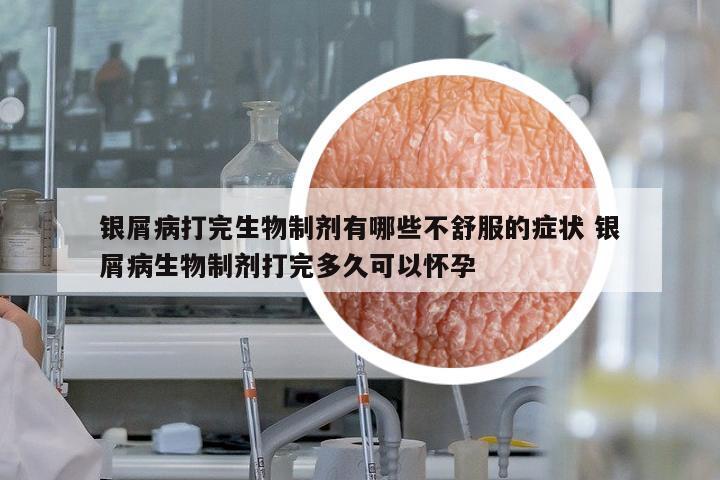 銀屑病打完生物制劑有哪些不舒服的癥狀 銀屑病生物制劑打完多久可以懷孕