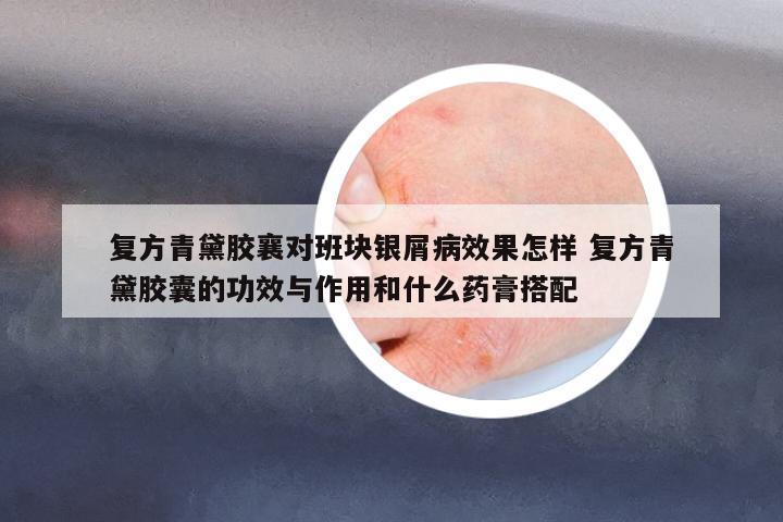 復方青黛膠襄對班塊銀屑病效果怎樣 復方青黛膠囊的功效與作用和什么藥膏搭配