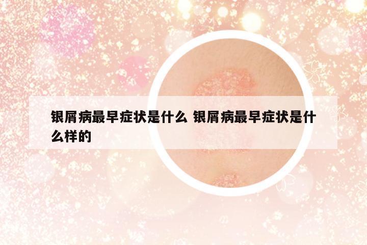 銀屑病最早癥狀是什么 銀屑病最早癥狀是什么樣的