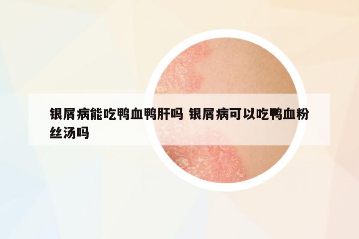 銀屑病能吃鴨血鴨肝嗎 銀屑病可以吃鴨血粉絲湯嗎