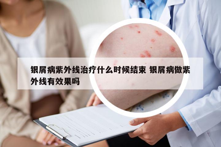 銀屑病紫外線治療什么時(shí)候結(jié)束 銀屑病做紫外線有效果嗎