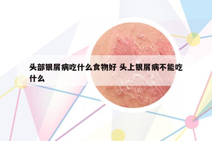 頭部銀屑病吃什么食物好 頭上銀屑病不能吃什么