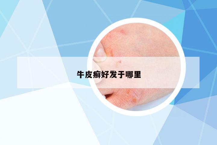 牛皮癬好發(fā)于哪里