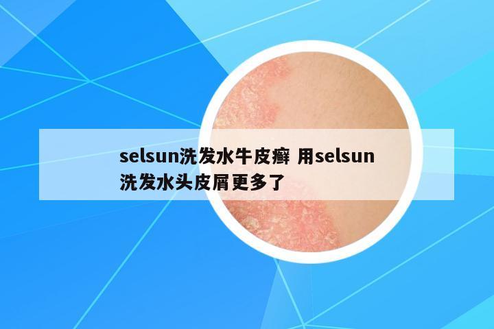 selsun洗發(fā)水牛皮癬 用selsun洗發(fā)水頭皮屑更多了
