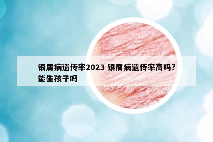 銀屑病遺傳率2023 銀屑病遺傳率高嗎?能生孩子嗎