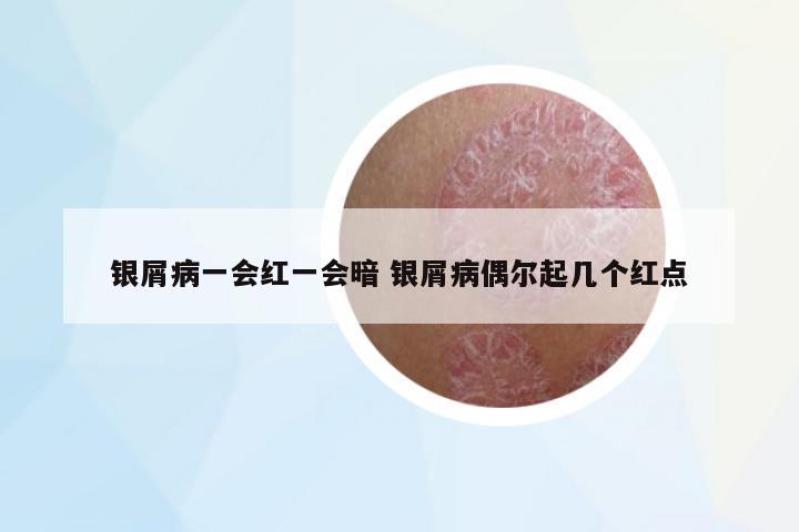 銀屑病一會(huì)紅一會(huì)暗 銀屑病偶爾起幾個(gè)紅點(diǎn)