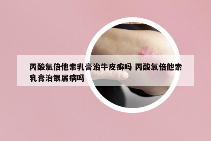 丙酸氯倍他索乳膏治牛皮癬嗎 丙酸氯倍他索乳膏治銀屑病嗎