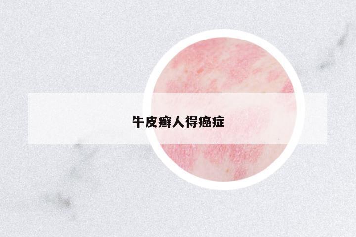 牛皮癬人得癌癥