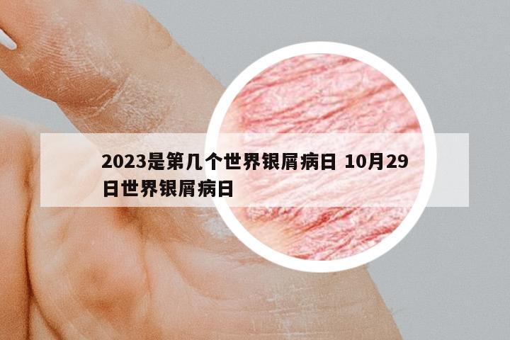 2023是第幾個(gè)世界銀屑病日 10月29日世界銀屑病日