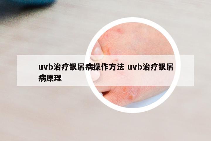 uvb治療銀屑病操作方法 uvb治療銀屑病原理