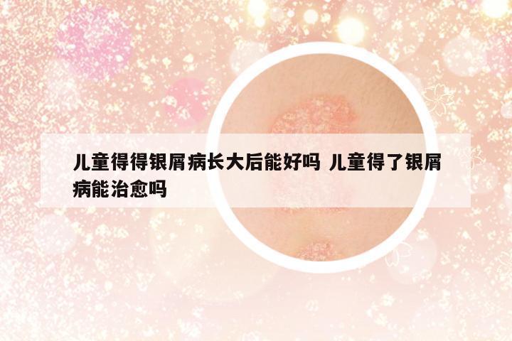 兒童得得銀屑病長大后能好嗎 兒童得了銀屑病能治愈嗎