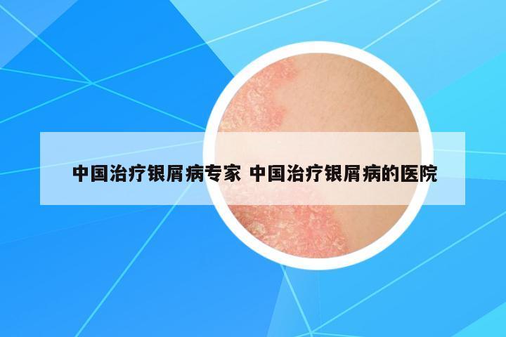中國(guó)治療銀屑病專家 中國(guó)治療銀屑病的醫(yī)院