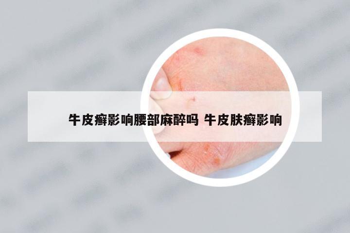 牛皮癬影響腰部麻醉嗎 牛皮膚癬影響