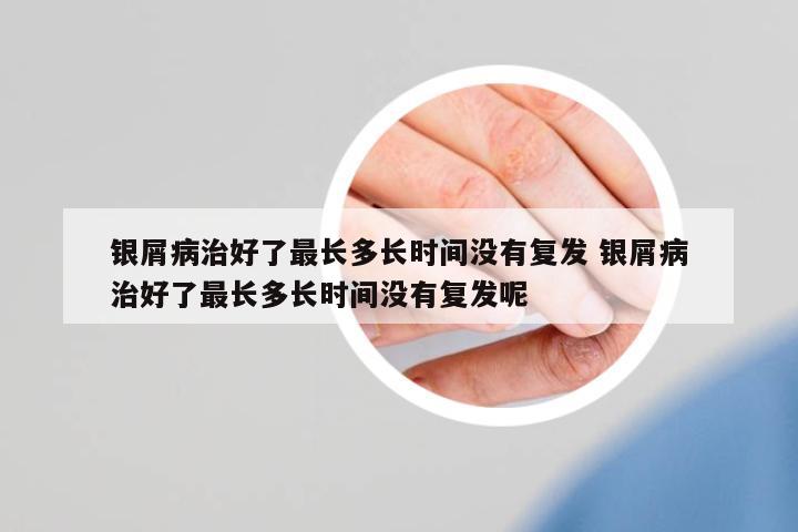 銀屑病治好了最長(zhǎng)多長(zhǎng)時(shí)間沒(méi)有復(fù)發(fā) 銀屑病治好了最長(zhǎng)多長(zhǎng)時(shí)間沒(méi)有復(fù)發(fā)呢