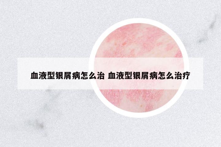 血液型銀屑病怎么治 血液型銀屑病怎么治療