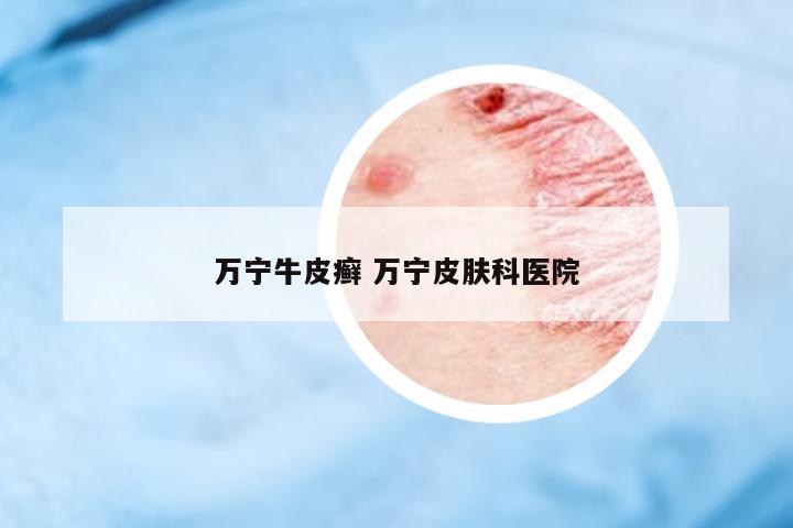 萬寧牛皮癬 萬寧皮膚科醫(yī)院