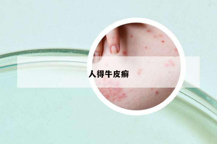 人得牛皮癬