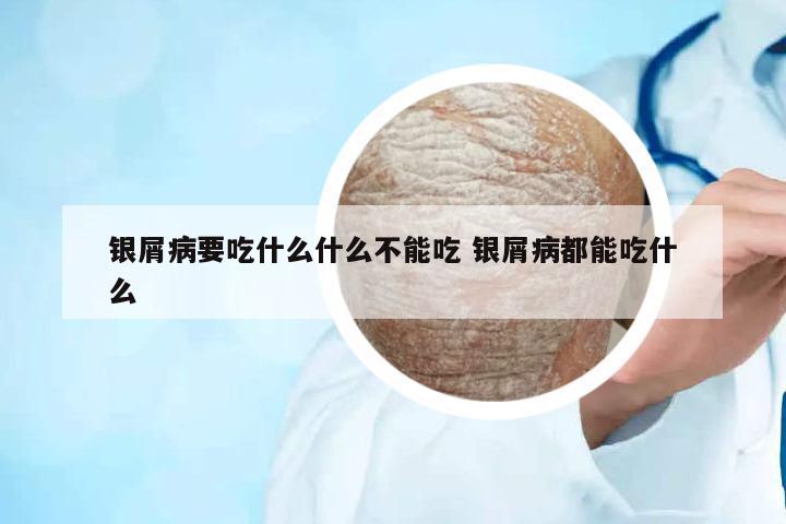 銀屑病要吃什么什么不能吃 銀屑病都能吃什么