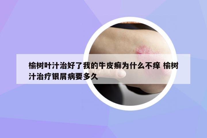 榆樹葉汁治好了我的牛皮癬為什么不癢 榆樹汁治療銀屑病要多久