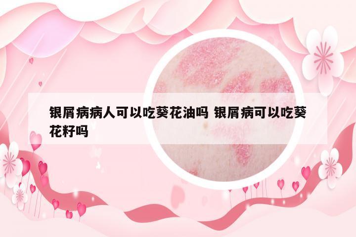 銀屑病病人可以吃葵花油嗎 銀屑病可以吃葵花籽嗎