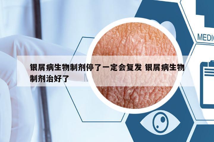 銀屑病生物制劑停了一定會復(fù)發(fā) 銀屑病生物制劑治好了
