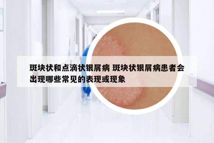 斑塊狀和點滴狀銀屑病 斑塊狀銀屑病患者會出現(xiàn)哪些常見的表現(xiàn)或現(xiàn)象