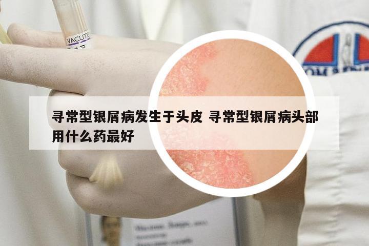 尋常型銀屑病發(fā)生于頭皮 尋常型銀屑病頭部用什么藥最好