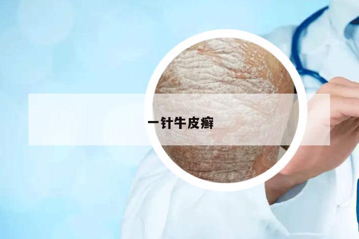 一針牛皮癬