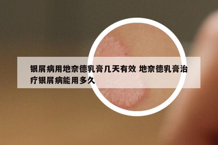 銀屑病用地奈德乳膏幾天有效 地奈德乳膏治療銀屑病能用多久
