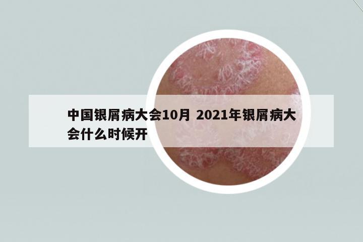 中國銀屑病大會10月 2021年銀屑病大會什么時候開