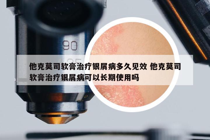 他克莫司軟膏治療銀屑病多久見效 他克莫司軟膏治療銀屑病可以長期使用嗎