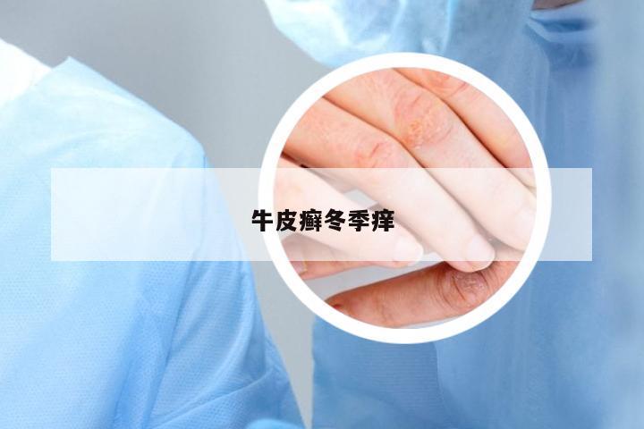 牛皮癬冬季癢