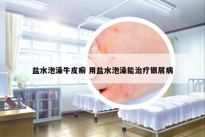 鹽水泡澡牛皮癬 用鹽水泡澡能治療銀屑病