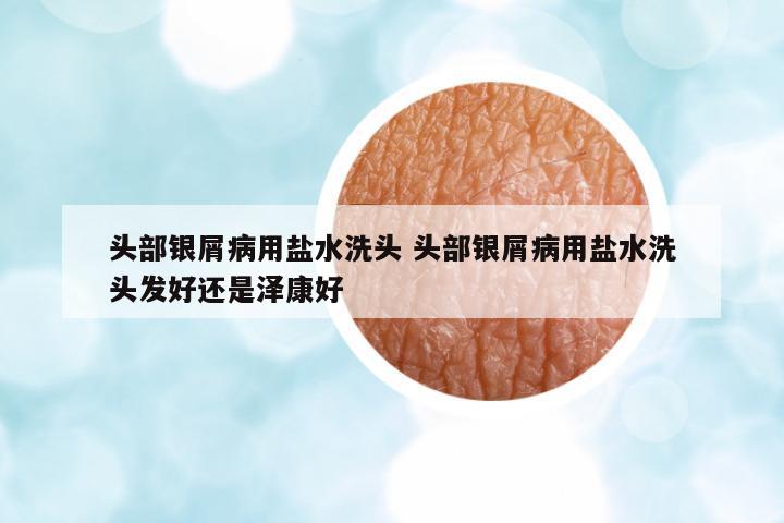 頭部銀屑病用鹽水洗頭 頭部銀屑病用鹽水洗頭發(fā)好還是澤康好